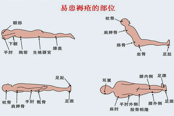 家庭必备护理常识丨冬季褥疮高发，长期卧床老人如何预防褥疮？